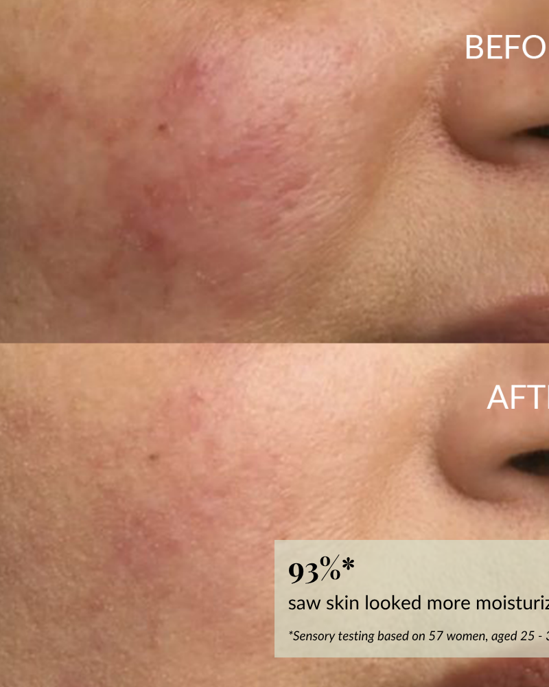 Close-up of a woman's cheek before and after skincare, showing reduced redness and smoother skin after using IREN Shizen DROP OF DEW Moisturizing Facial Oil. 93% saw more moisturized skin; formulated with cold-pressed oils for barrier repair.