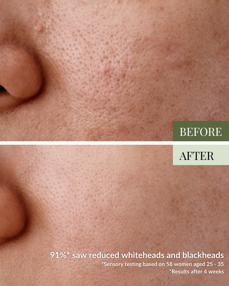 Close-up of a person's cheek and nose shows skin texture before and after using the GLOW UP Anti-Aging Discovery Kit by IREN Shizen; the after image reveals smoother skin with reduced pores and blemishes.