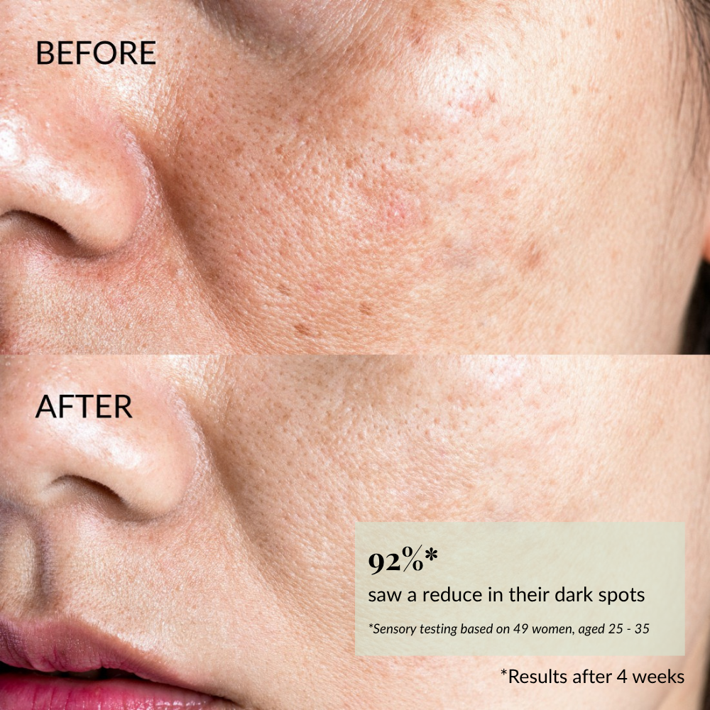 Close-up of a cheek with fewer dark spots and smoother skin after using STAR LIGHT Brightening Serum by IREN Shizen; 92% saw reduced dark spots and improved hyperpigmentation in 4 weeks. #show-lang-en