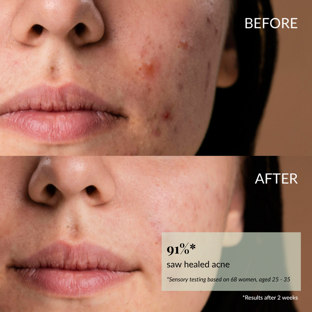 Close-up of a woman's lower face, showing acne before (top) and clearer skin after using the CLEAR UP Anti-Blemish Discovery Kit by IREN Shizen (bottom), with text highlighting a 91% acne healing rate.