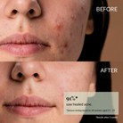 Close-up of a woman's lower face showing acne before use (top) and clearer skin after using IREN Shizen CLEARER DAYS Anti-Blemish Serum (bottom), with text stating 91% saw healed acne after two weeks. #show-lang-en