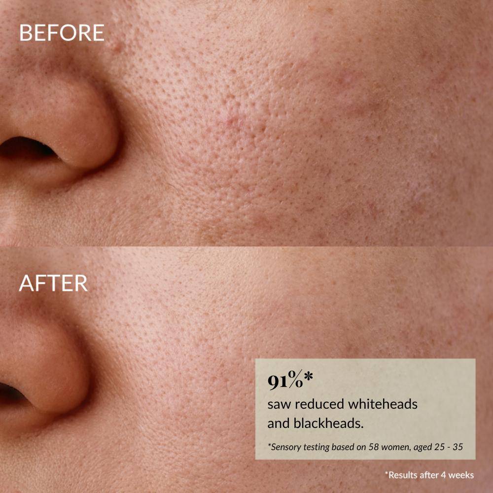 Close-up of a cheek and nose shows visible pores and blemishes before using IREN Shizen GLOW-GETTER Renewal Serum, and clearer, smoother skin after. Text highlights 91% improvement. #show-lang-en