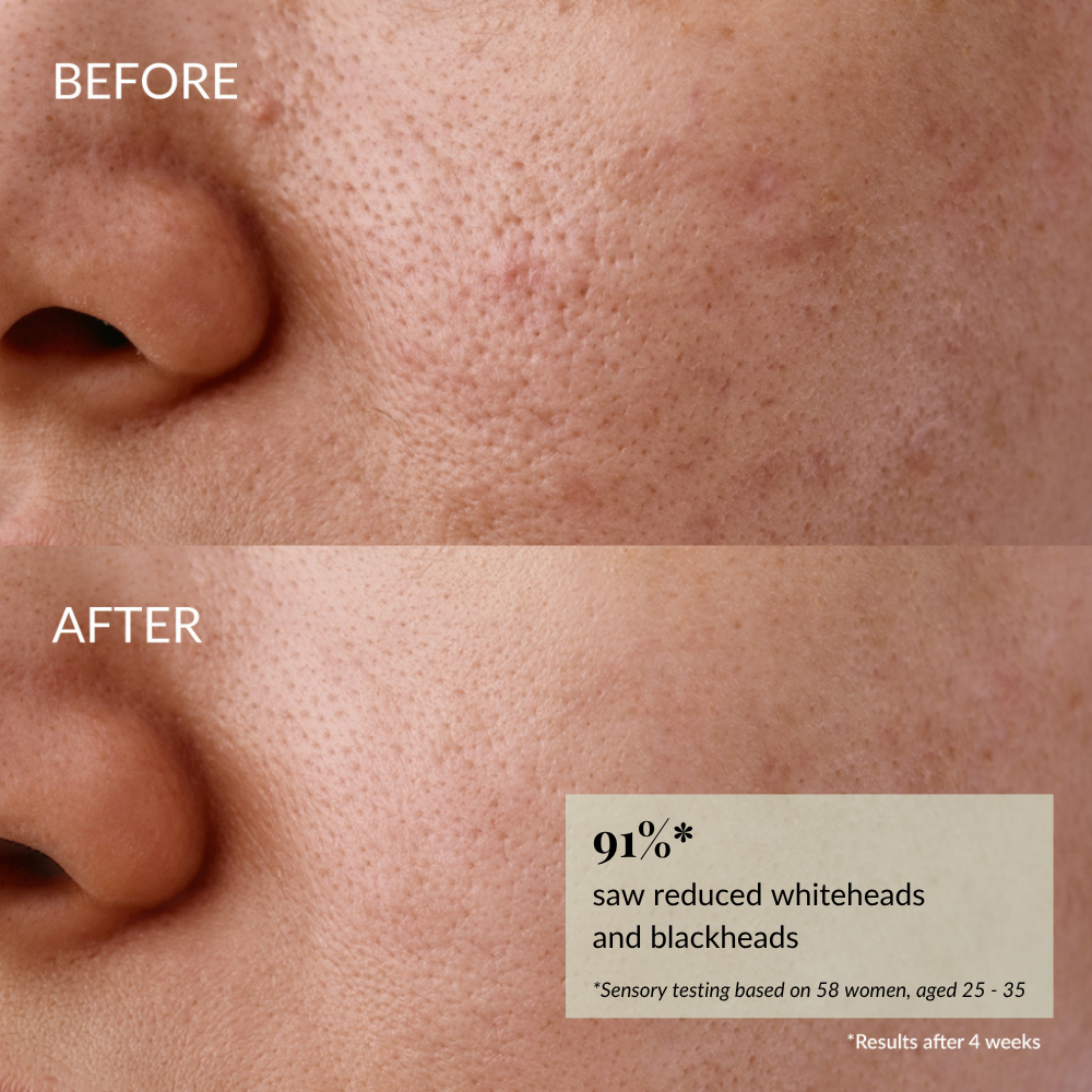 Close-up of a person's cheek and nose shows visible pores and blemishes before, then smoother, clearer skin after using the GLOW UP Anti-Aging Discovery Kit by IREN Shizen. #show-lang-en