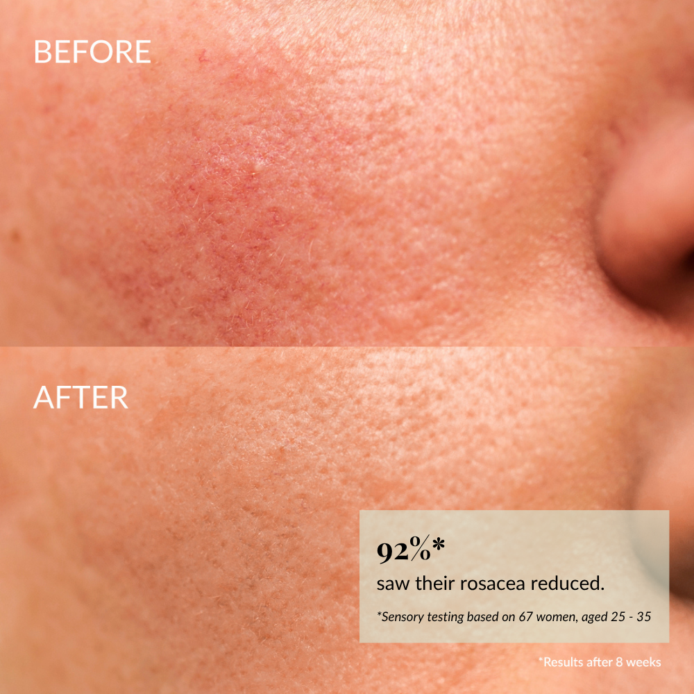 Close-up of sensitive skin shows redness and texture in the "before" image, while the "after" image reveals smoother, clearer skin with reduced rosacea. Text: 92% saw improvement after 8 weeks using IREN Shizen KEEP CALM Soothing Serum. #show-lang-en