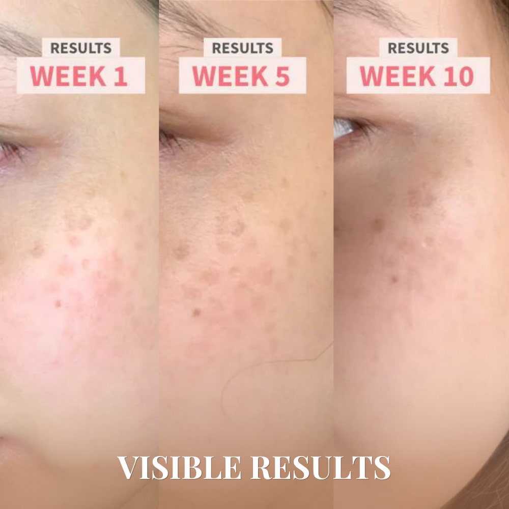 Close-up of a cheek at week 1, 5, and 10 after using IREN Shizen SKIN GENIE PRO Cleansing Brush + LED Light Therapy shows visible reduction in dark spots and uneven tone. Text: "VISIBLE RESULTS.