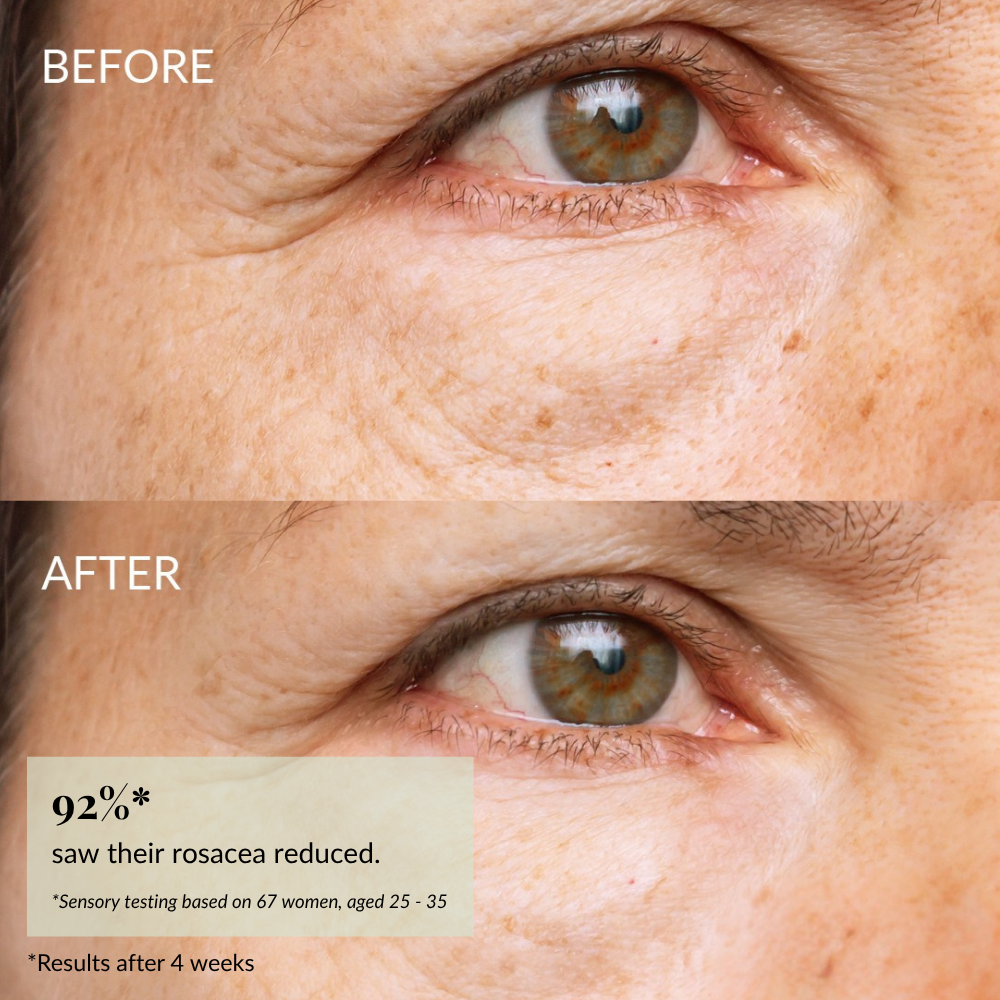 Close-up "Before" and "After" images reveal reduced redness, smoother skin, and brighter under-eyes after using IREN Shizen’s SKIN REBOOT Antioxidant Serum. Text highlights rosacea improvement and diminished dark circles. #show-lang-en